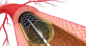 Divisi Jantung dan Pembuluh Darah Kardiologi Intervensi
